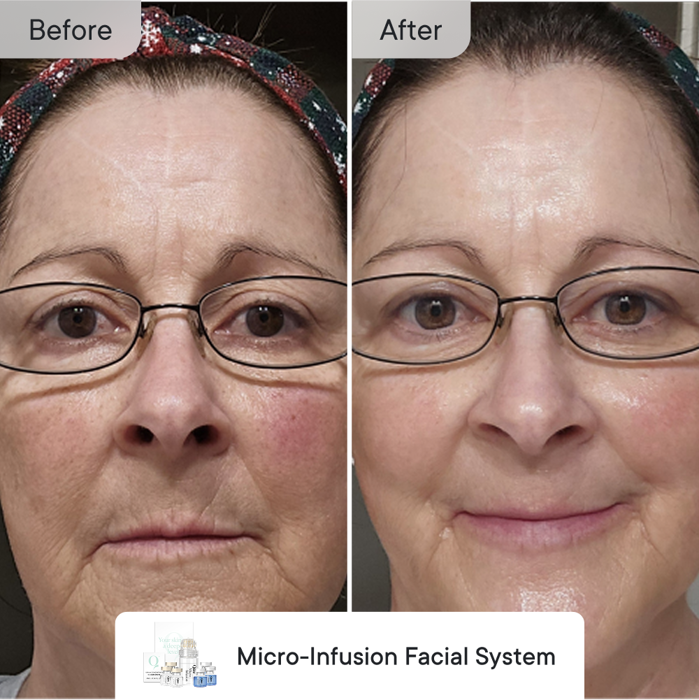 Line Refine Bundle Essential