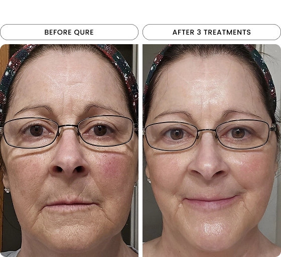 Micro-Infusion 6 Month (For Wrinkles + Dark Spots) (Pre-order)